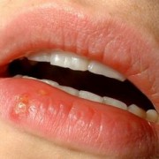Herpesul bucal, inestetic și neplăcut. Cum îl tratăm ?