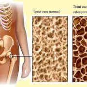 Terapia Nefarmacologicã în Osteoporozã