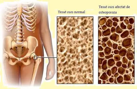 Terapia Nefarmacologicã în Osteoporozã